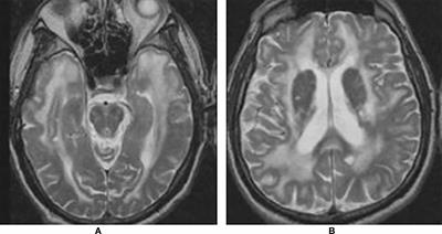 Pathophysiological Mechanisms and Potential Therapeutic Targets in Cerebral Autosomal Dominant Arteriopathy With Subcortical Infarcts and Leukoencephalopathy (CADASIL)